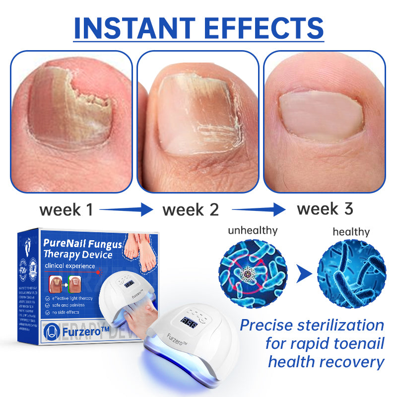 ✨✨✨Furzero™ Pure Nail Fungus Laser Therapy Device