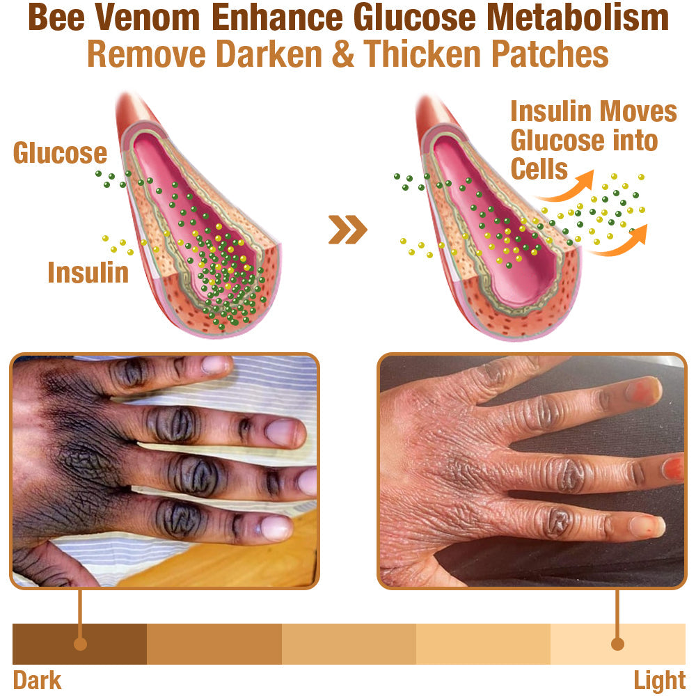 GFOUK™ ShineLuster Acanthosis Nigricans Bee Venom Soap