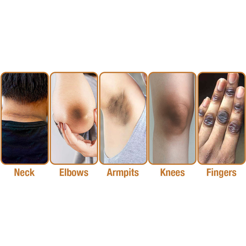 GFOUK™ ShineLuster Acanthosis Nigricans Bee Venom Soap