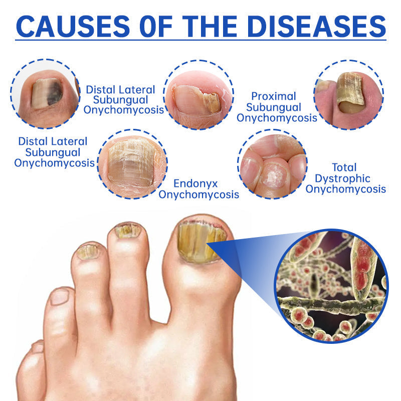 ✨✨Furzero™ Pure Nail Fungus Laser Therapy Device