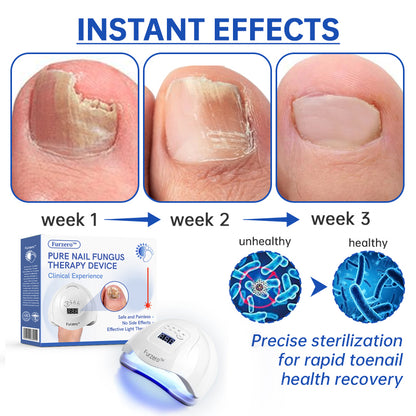 ⭐️Furzero™ Pure Nail Fungus Laser Therapy Device