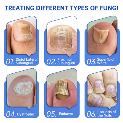 ⭐️⭐️⭐️Furzero™ Pure Nail Fungus Laser Therapy Device